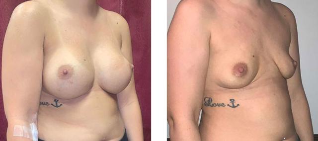 Breast Lift result at Whitlock Cosmetic Center of Oklahoma in Tulsa, OK