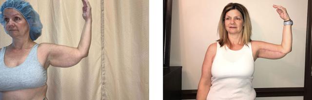 Arm Lift result at Whitlock Cosmetic Center of Oklahoma in Tulsa, OK