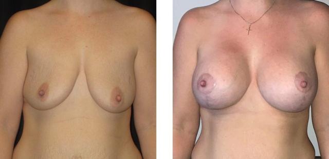 Breast Lift result at Whitlock Cosmetic Center of Oklahoma in Tulsa, OK