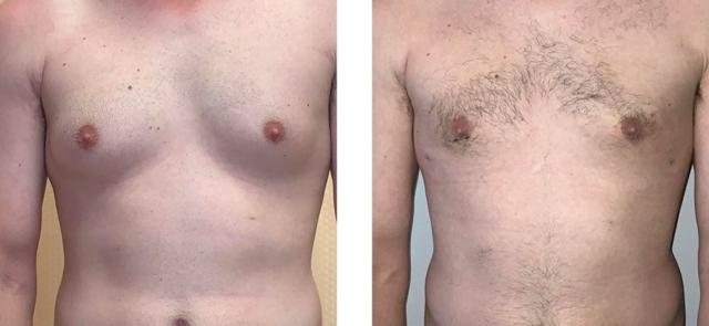 Gynecomastia Surgery result at Whitlock Cosmetic Center of Oklahoma in Tulsa, OK