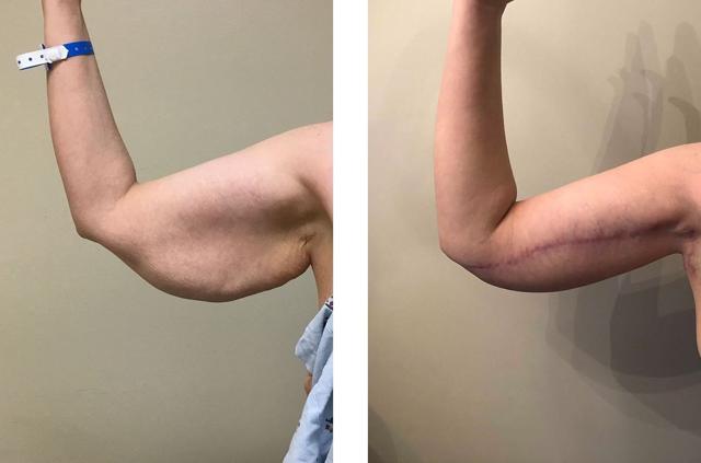 Arm Lift result at Whitlock Cosmetic Center of Oklahoma in Tulsa, OK