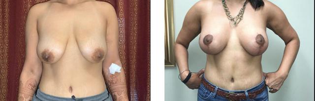Breast Augmentation result at Whitlock Cosmetic Center of Oklahoma in Tulsa, OK