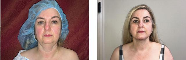 Brazilian Butt Lift result at Whitlock Cosmetic Center of Oklahoma in Tulsa, OK
