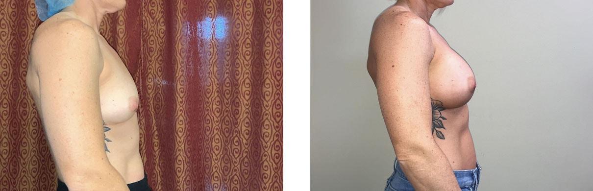 Whitlock Cosmetic Center of Oklahoma breast augmentation result — Tulsa, OK