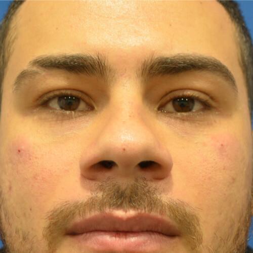 Philadelphia Facial Plastic Surgery & Medspa after — Philadelphia, PA