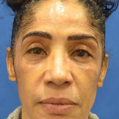 Blepharoplasty after at Philadelphia Facial Plastic Surgery & Medspa in Philadelphia, PA