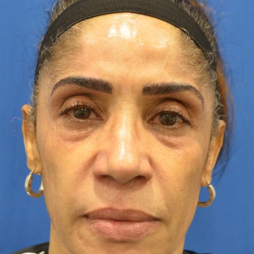 Blepharoplasty before at Philadelphia Facial Plastic Surgery & Medspa in Philadelphia, PA
