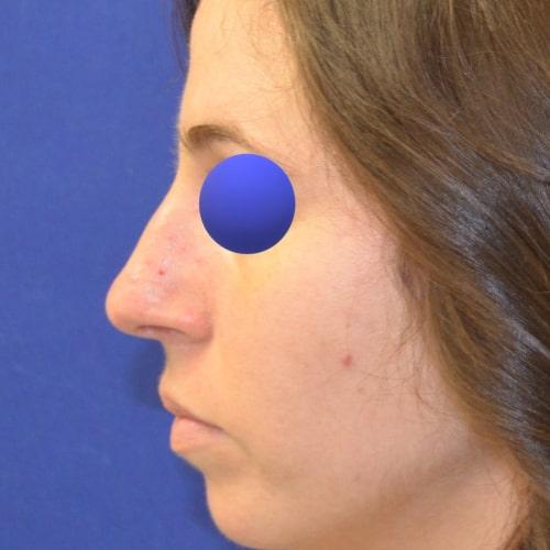 Philadelphia Facial Plastic Surgery & Medspa rhinoplasty after — Philadelphia, PA