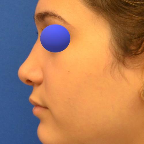 Philadelphia Facial Plastic Surgery & Medspa rhinoplasty after — Philadelphia, PA