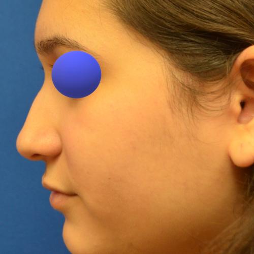 Rhinoplasty before at Philadelphia Facial Plastic Surgery & Medspa in Philadelphia, PA