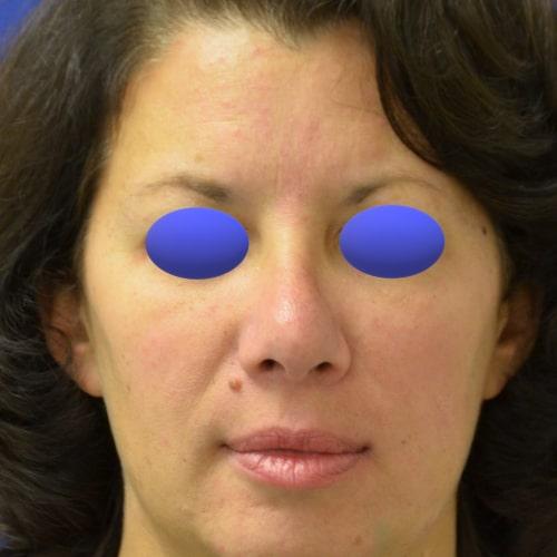 Philadelphia Facial Plastic Surgery & Medspa rhinoplasty after — Philadelphia, PA