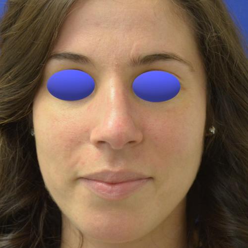 Philadelphia Facial Plastic Surgery & Medspa rhinoplasty after — Philadelphia, PA