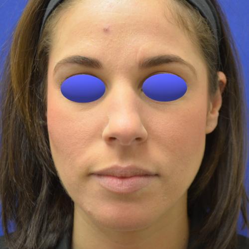 Functional Rhinoplasty before at Philadelphia Facial Plastic Surgery & Medspa in Philadelphia, PA