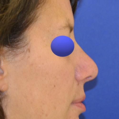 Philadelphia Facial Plastic Surgery & Medspa rhinoplasty after — Philadelphia, PA