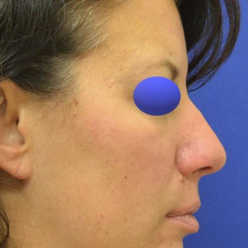 Rhinoplasty before at Philadelphia Facial Plastic Surgery & Medspa in Philadelphia, PA