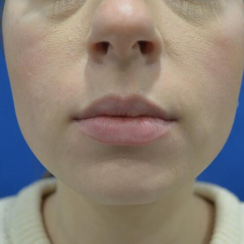 Lip Filler after at Philadelphia Facial Plastic Surgery & Medspa in Philadelphia, PA