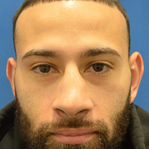Rhinoplasty before at Philadelphia Facial Plastic Surgery & Medspa in Philadelphia, PA