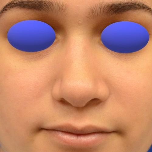 Philadelphia Facial Plastic Surgery & Medspa rhinoplasty after — Philadelphia, PA