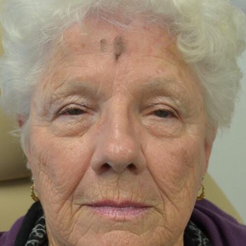 Brow Lift after at Philadelphia Facial Plastic Surgery & Medspa in Philadelphia, PA