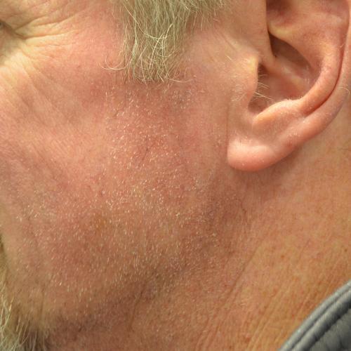 Philadelphia Facial Plastic Surgery & Medspa after — Philadelphia, PA