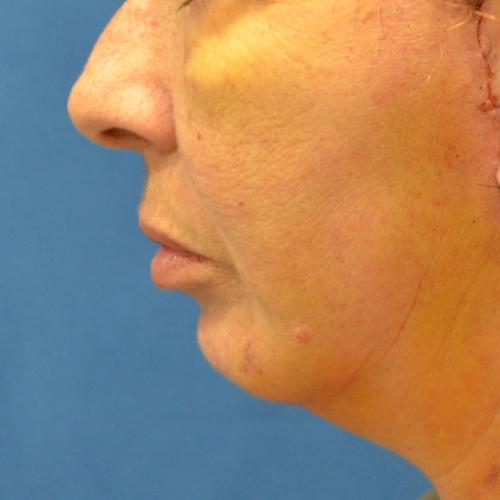 Philadelphia Facial Plastic Surgery & Medspa chin implant after — Philadelphia, PA