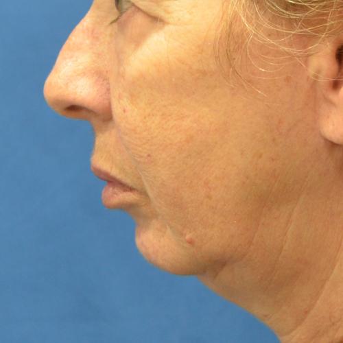 Chin Implant before at Philadelphia Facial Plastic Surgery & Medspa in Philadelphia, PA