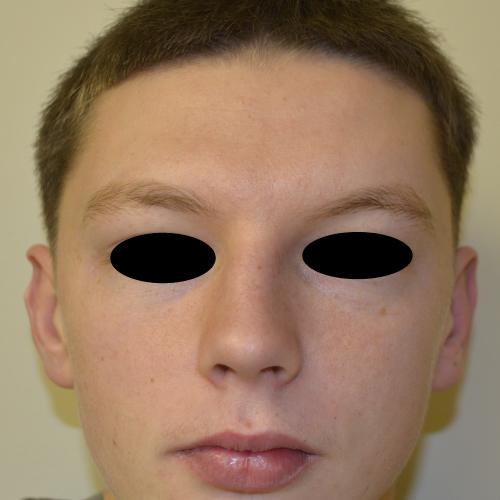 Philadelphia Facial Plastic Surgery & Medspa rhinoplasty after — Philadelphia, PA