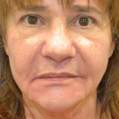 Philadelphia Facial Plastic Surgery & Medspa breast augmentation after — Philadelphia, PA