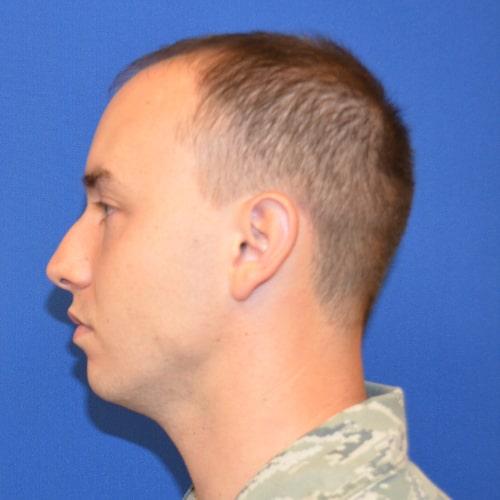 Rhinoplasty before at Philadelphia Facial Plastic Surgery & Medspa in Philadelphia, PA