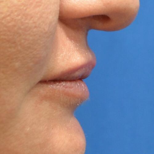Philadelphia Facial Plastic Surgery & Medspa lip filler after — Philadelphia, PA