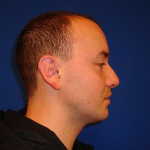 Functional Rhinoplasty after at Philadelphia Facial Plastic Surgery & Medspa in Philadelphia, PA