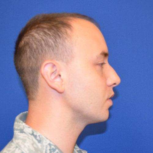 Functional Rhinoplasty before at Philadelphia Facial Plastic Surgery & Medspa in Philadelphia, PA