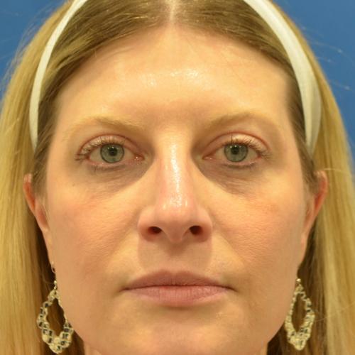 Blepharoplasty after at Philadelphia Facial Plastic Surgery & Medspa in Philadelphia, PA