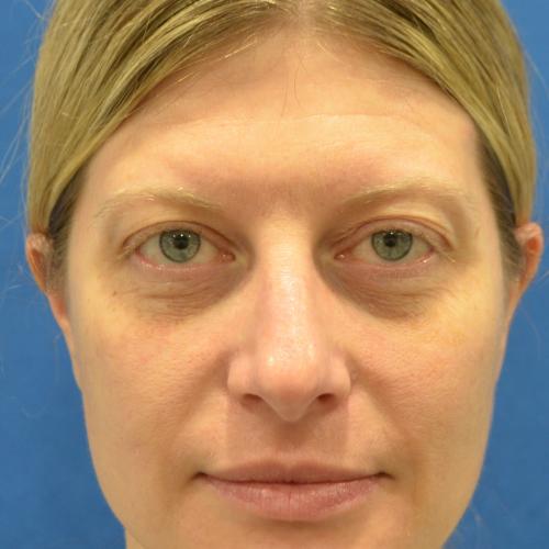 Blepharoplasty before at Philadelphia Facial Plastic Surgery & Medspa in Philadelphia, PA