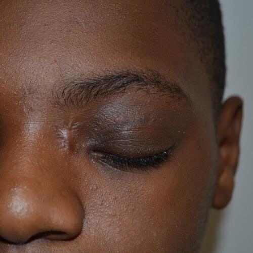 Blepharoplasty after at Philadelphia Facial Plastic Surgery & Medspa in Philadelphia, PA
