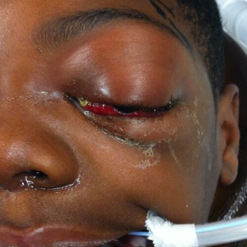 Blepharoplasty before at Philadelphia Facial Plastic Surgery & Medspa in Philadelphia, PA