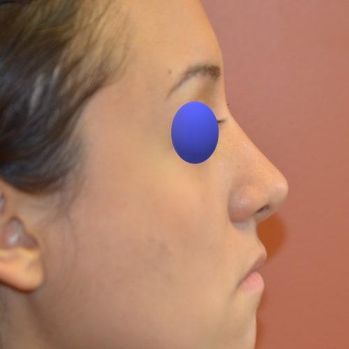 Philadelphia Facial Plastic Surgery & Medspa rhinoplasty after — Philadelphia, PA