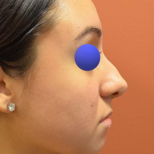 Rhinoplasty before at Philadelphia Facial Plastic Surgery & Medspa in Philadelphia, PA