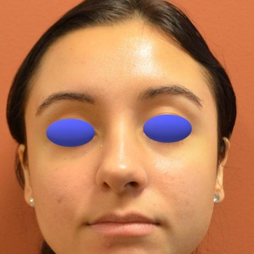 Philadelphia Facial Plastic Surgery & Medspa rhinoplasty after — Philadelphia, PA