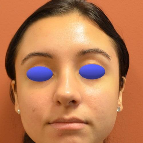 Functional Rhinoplasty before at Philadelphia Facial Plastic Surgery & Medspa in Philadelphia, PA