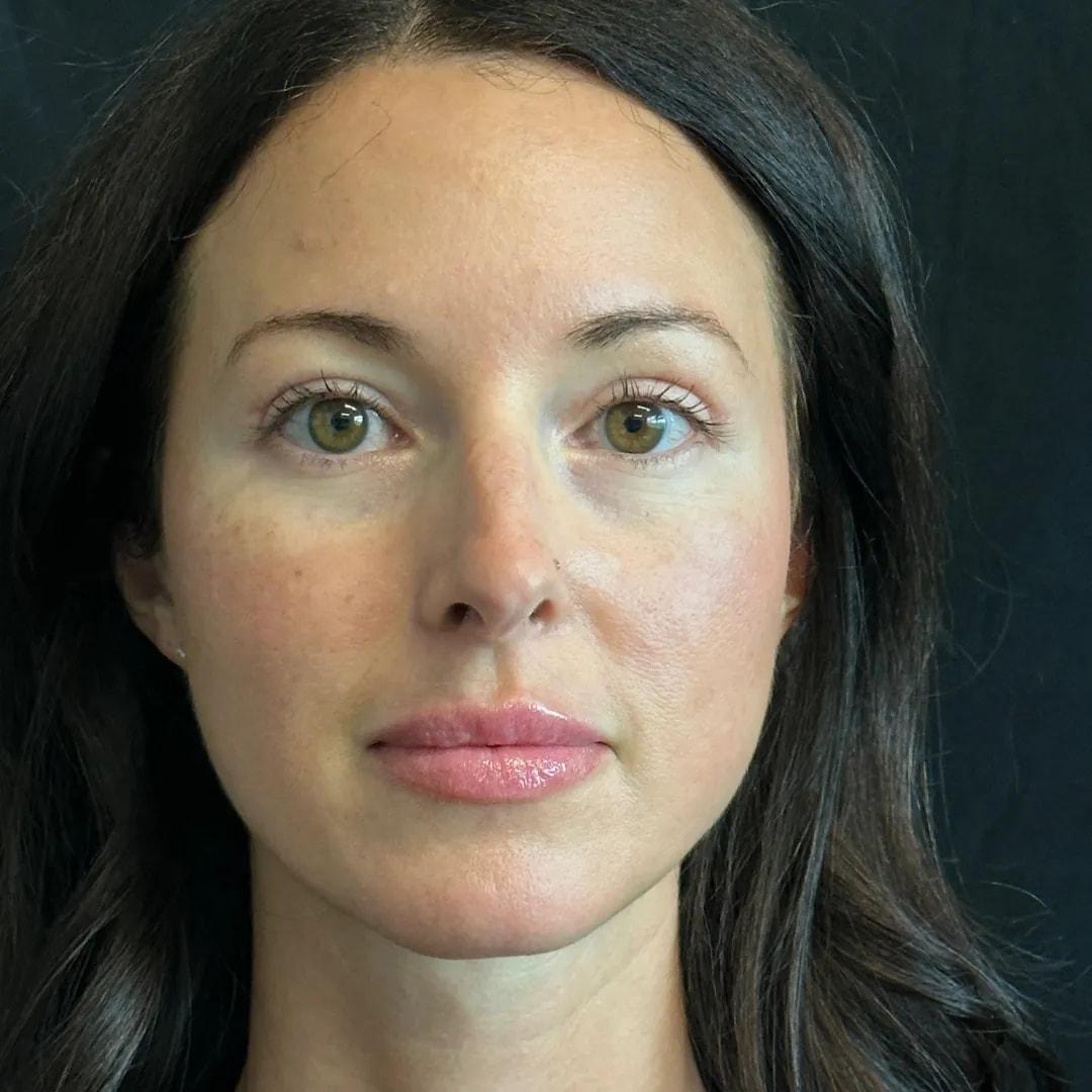Politis Plastic Surgery eyelid lift after — Tampa, FL