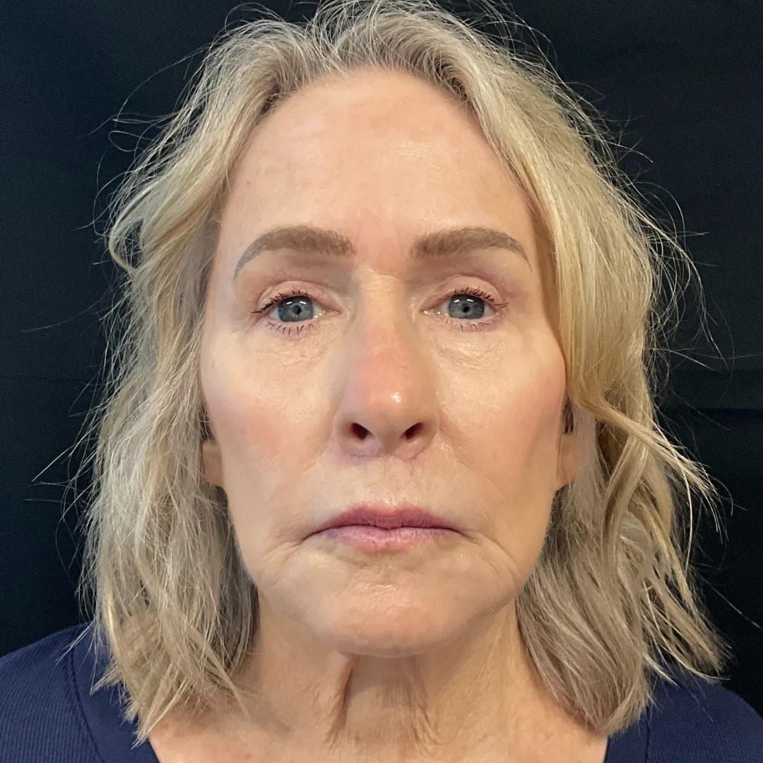 Politis Plastic Surgery eyelid lift after — Tampa, FL