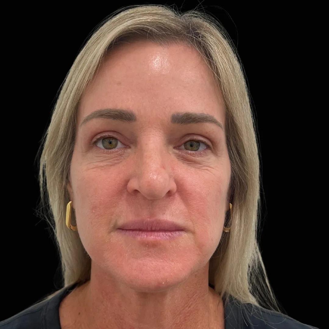 Politis Plastic Surgery eyelid lift after — Tampa, FL