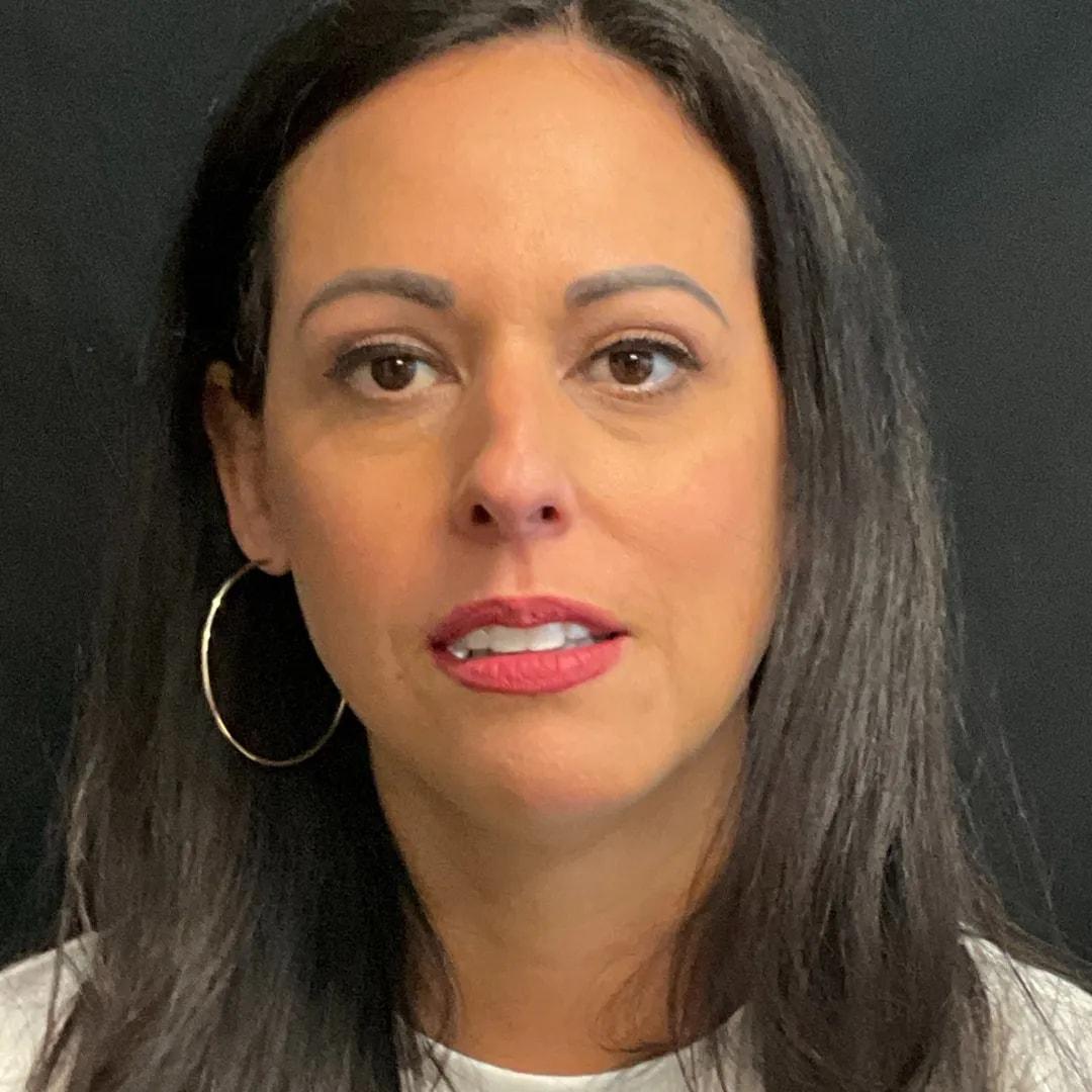 Politis Plastic Surgery eyelid lift after — Tampa, FL