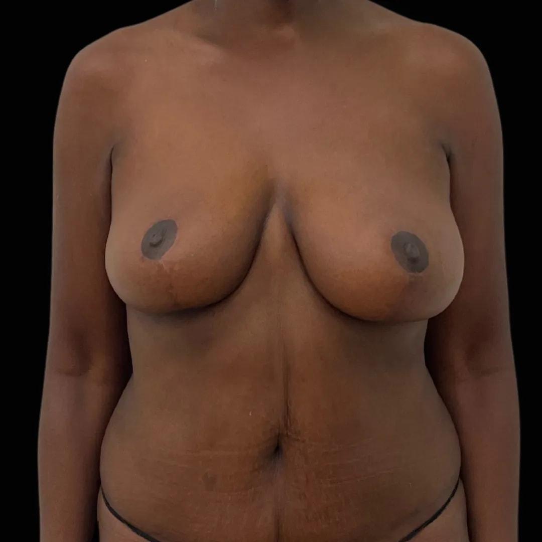 Politis Plastic Surgery breast lift after — Tampa, FL