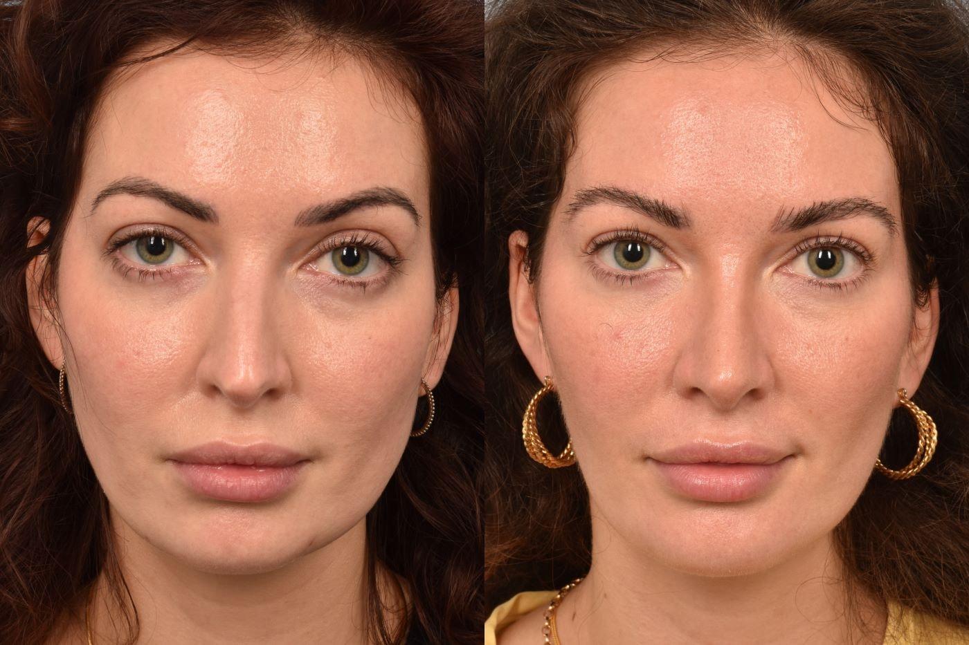 Pearlman Aesthetic Surgery buccal fat removal result — New York, NY