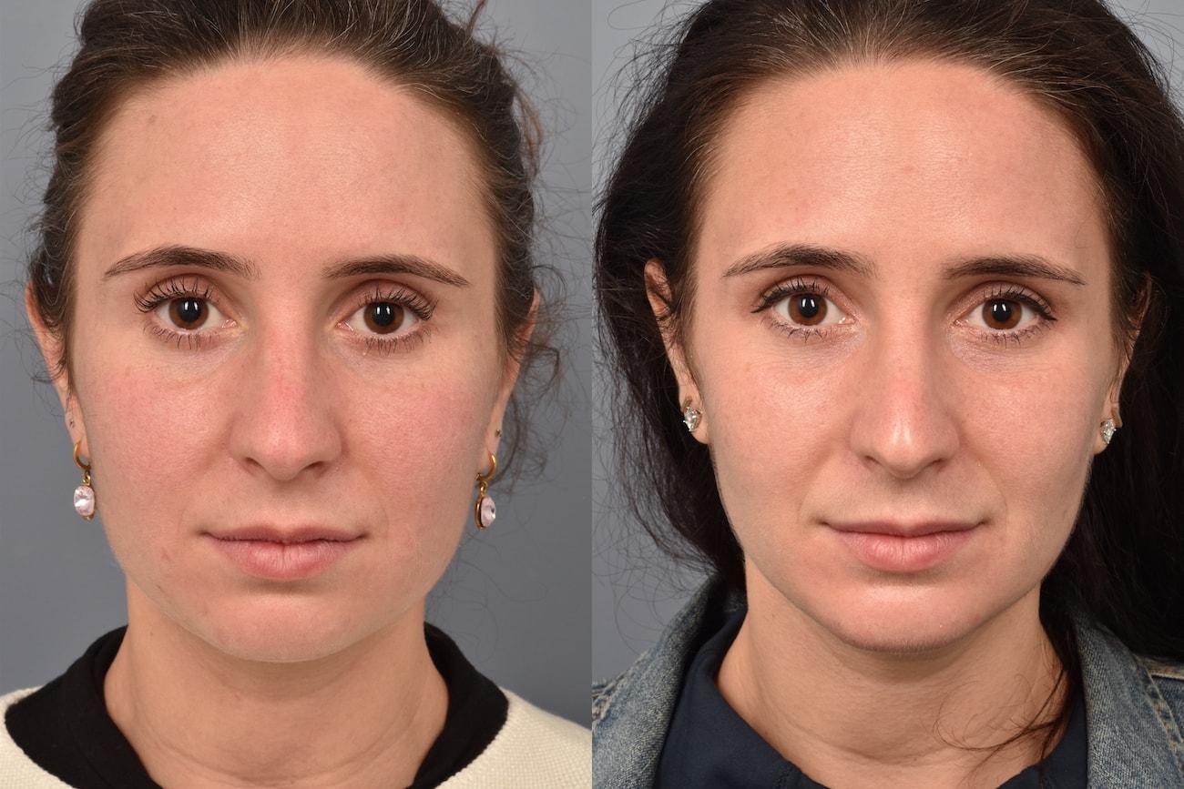 Pearlman Aesthetic Surgery buccal fat removal result — New York, NY