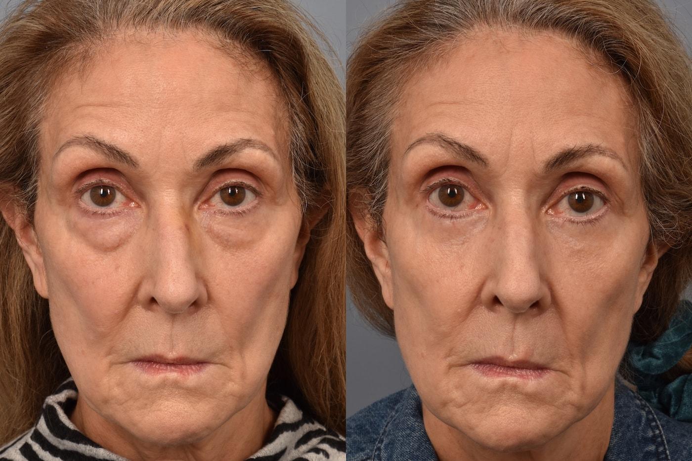 Pearlman Aesthetic Surgery eyelid lift result — New York, NY