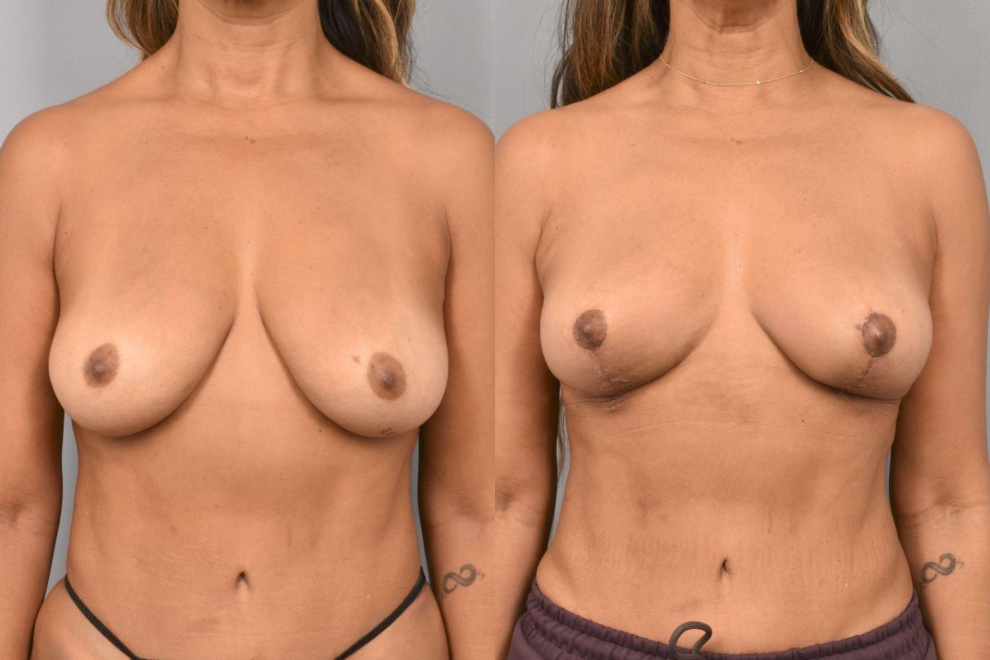 Pearlman Aesthetic Surgery breast lift result — New York, NY