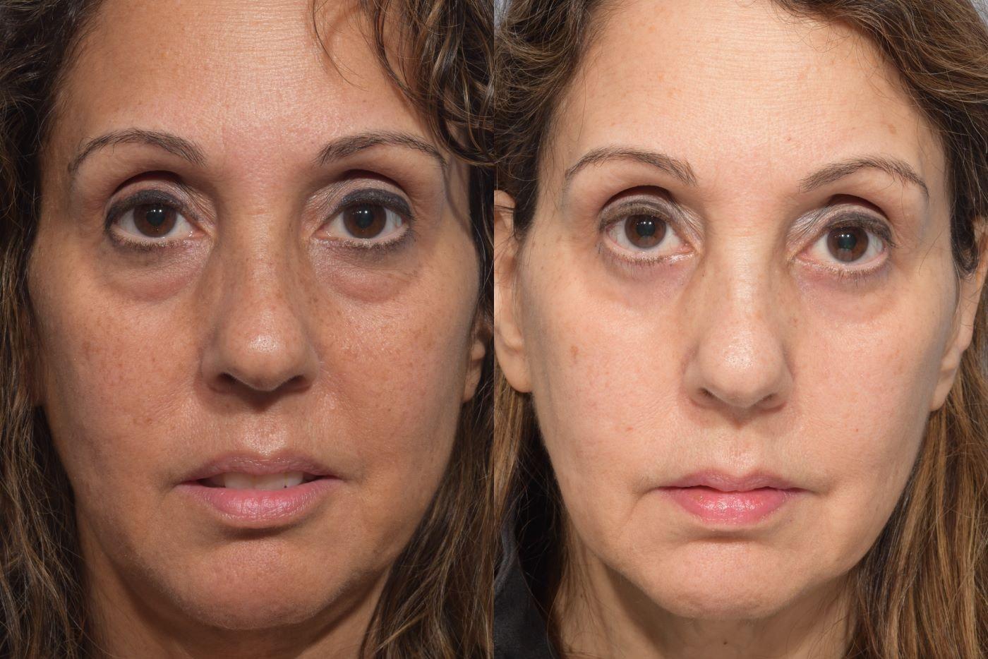 Pearlman Aesthetic Surgery eyelid lift result — New York, NY
